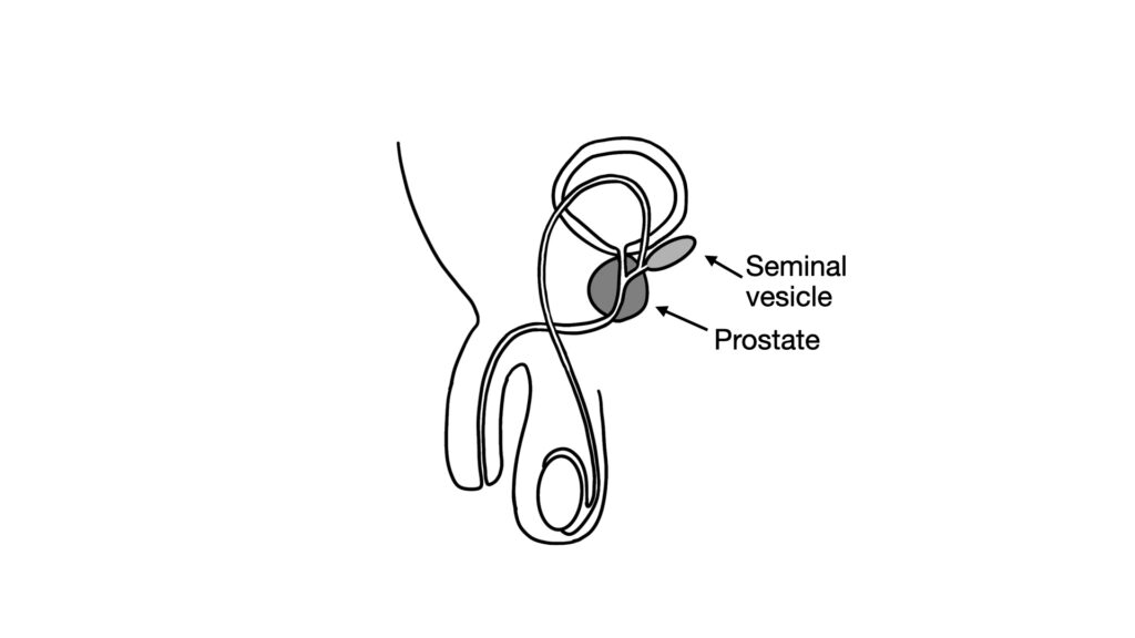 diagram of prostate and seminal vesicle - John Curington MD